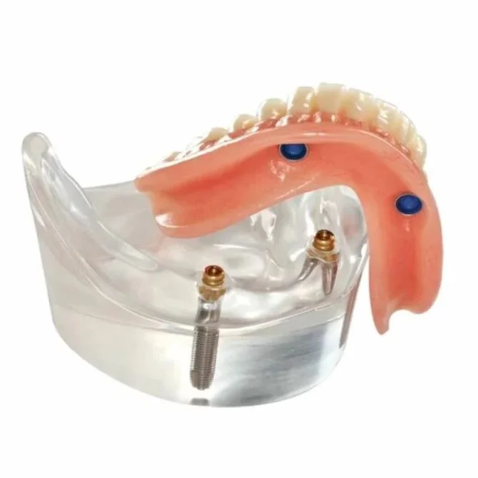 implant dentures tempe az