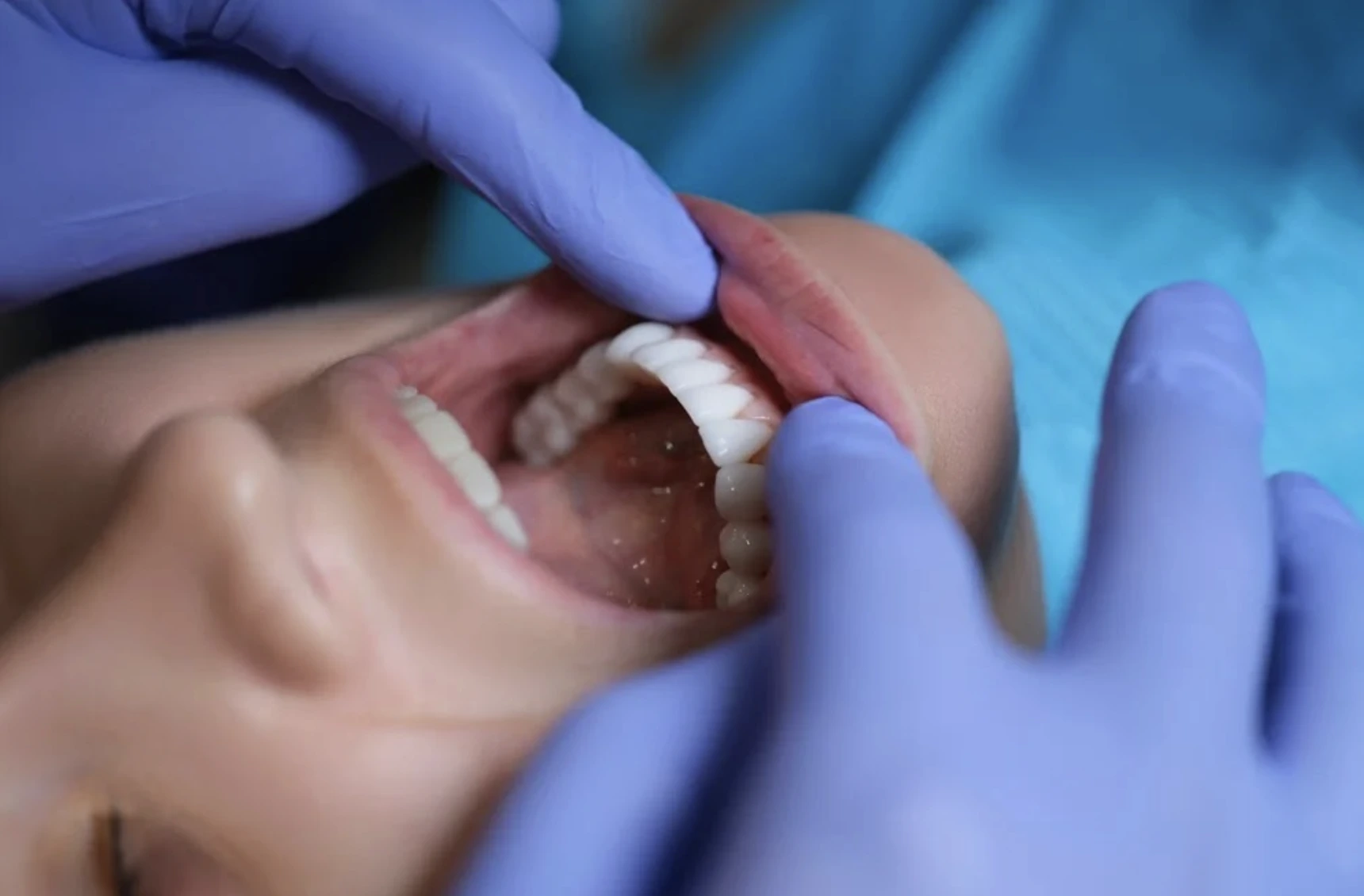 Composite vs. Porcelain Veneers: Which One is Right for You?